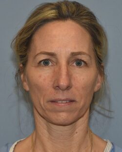 Facelift