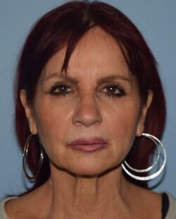 Facelift