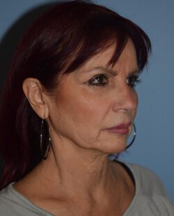 Facelift