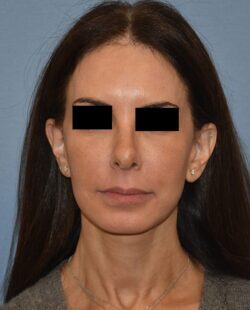 Facelift