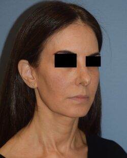 Facelift