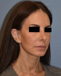 Facelift
