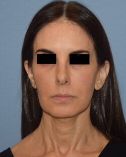 Facelift