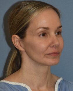 Facelift