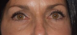 Blepharoplasty