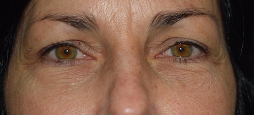 Under eye bag removal results