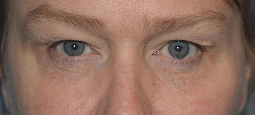Upper eyelid lift before and after