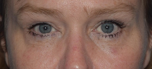 Eyelid surgery results photo