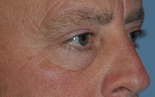 Lower Eyelid Blepharoplasty