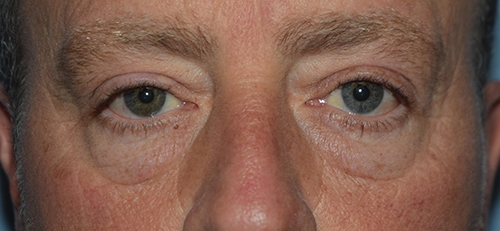 Lower Eyelid Blepharoplasty