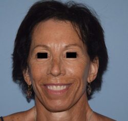 Facelift