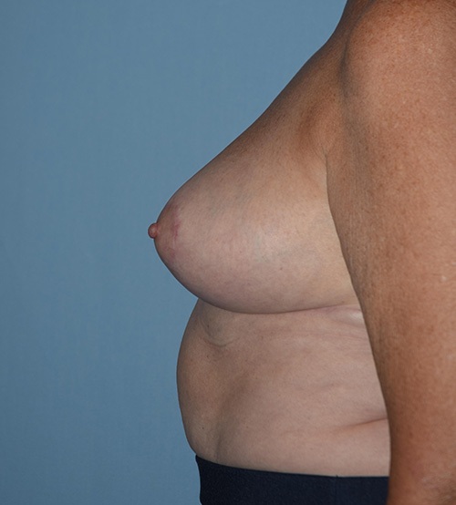 Breast Lift