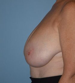 Breast Lift