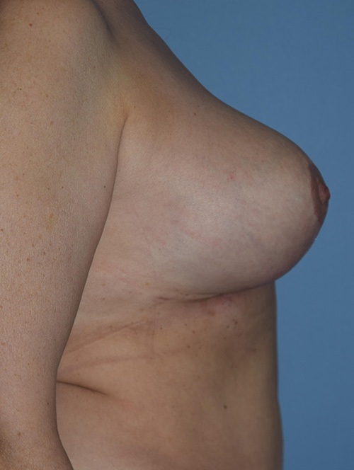 Breast Lift
