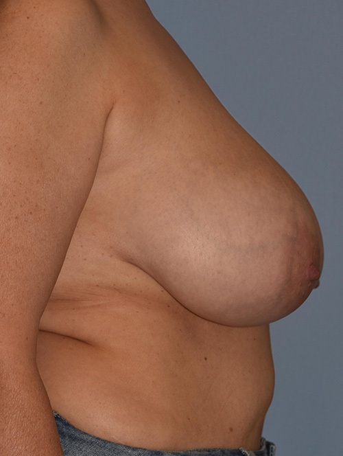 Breast Lift