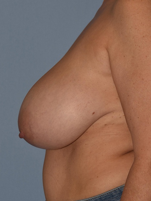 Breast Lift