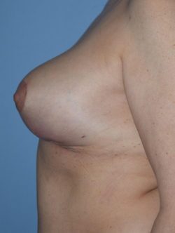Breast Lift