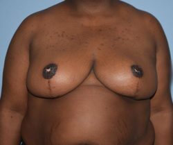 Breast Lift