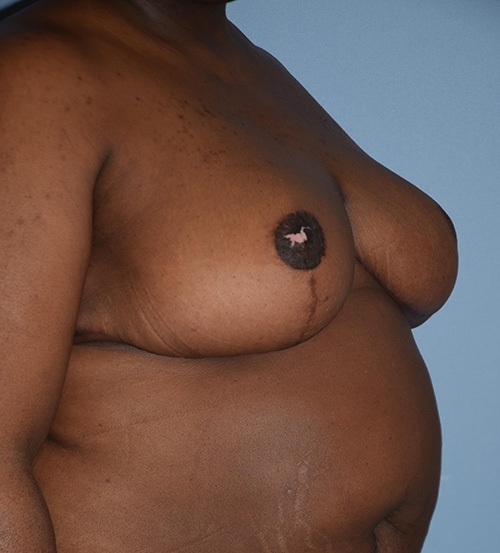 Breast Lift