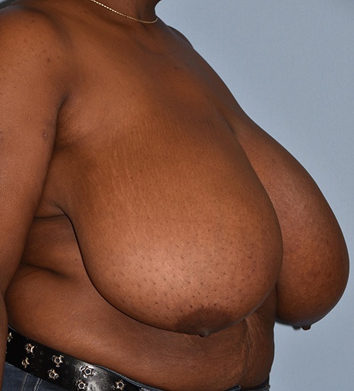Breast Lift