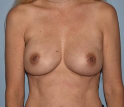 Breast Reconstruction (Implants)