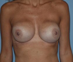 Breast Reconstruction (Implants)