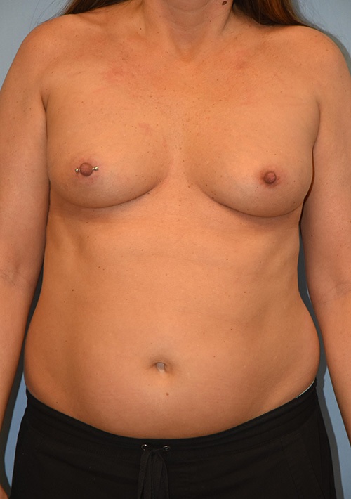 Liposuction Case 889 Before Photo Liposuction