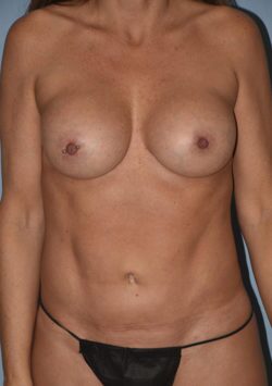 Liposuction