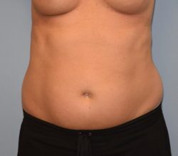 Liposuction
