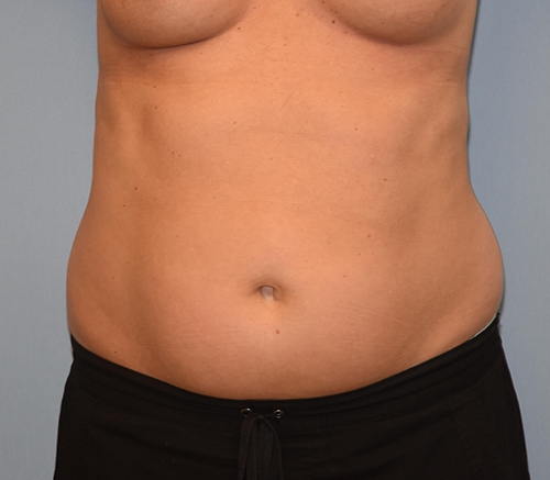 Liposuction before and after photo