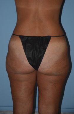 Liposuction