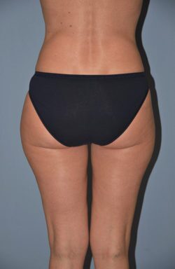 Liposuction