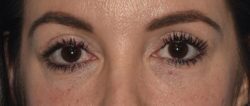 Upper Eyelid Blepharoplasty