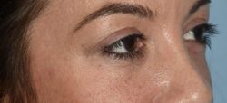 Upper Eyelid Blepharoplasty