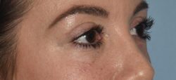 Upper Eyelid Blepharoplasty