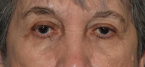 Upper Eyelid Blepharoplasty Case 1084 Before Photo Upper Eyelid Blepharoplasty