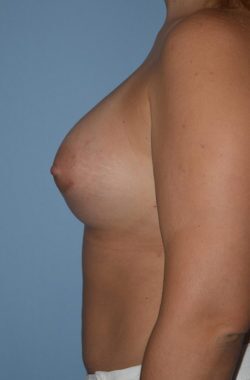 Breast Augmentation