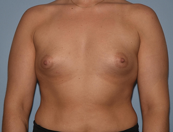 Breast Augmentation Case 1085 Before Photo Breast Augmentation