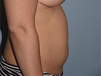 Liposuction