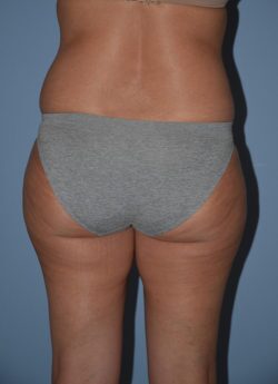 Liposuction