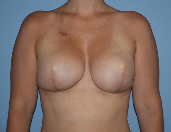 Breast Reconstruction (Implants) Case 1190 After Photo Breast Reconstruction (Implants)