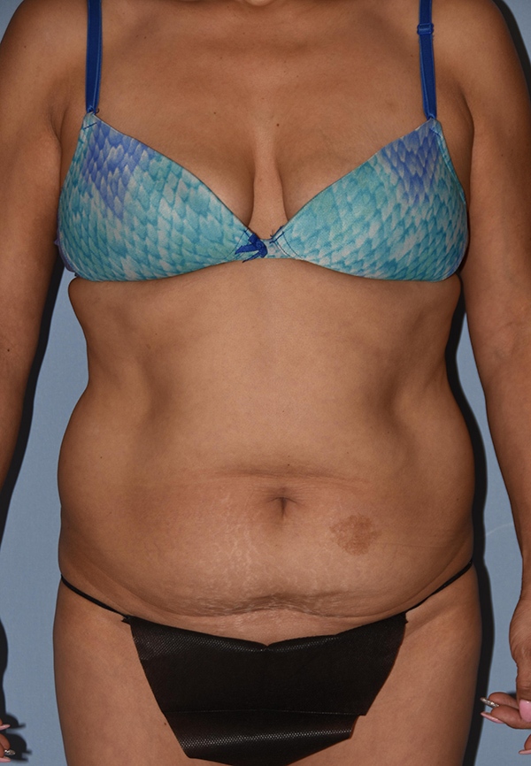 Tummy Tuck Case 1208 Before Photo Tummy Tuck