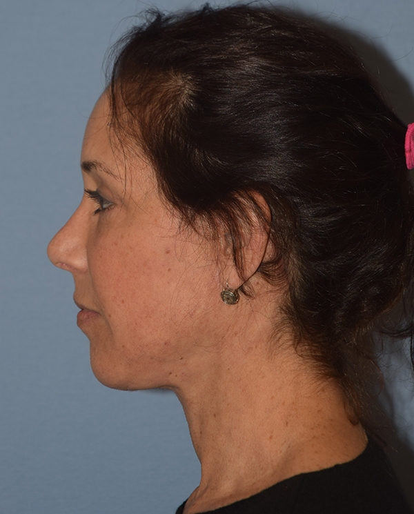 Facelift