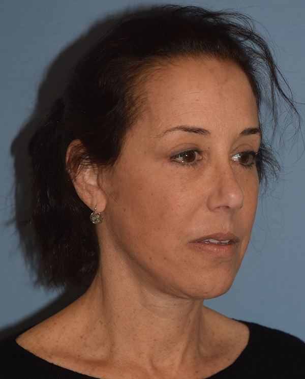 Facelift