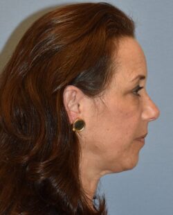 Facelift