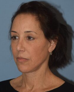 Facelift