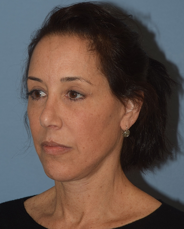 Facelift
