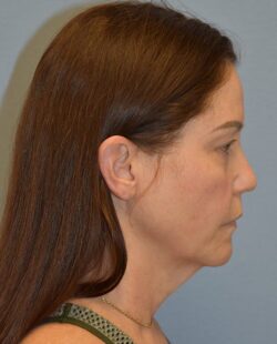 Facelift