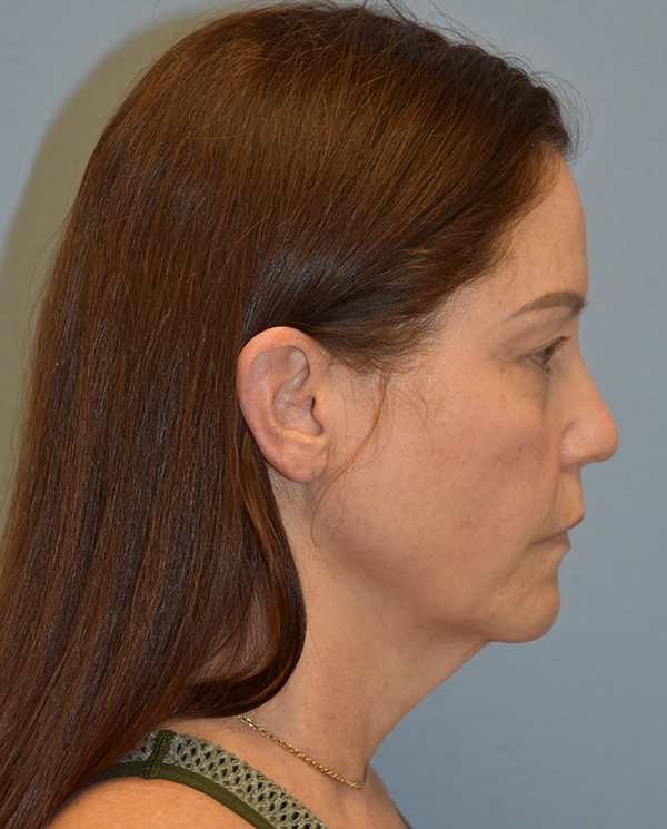 Facelift
