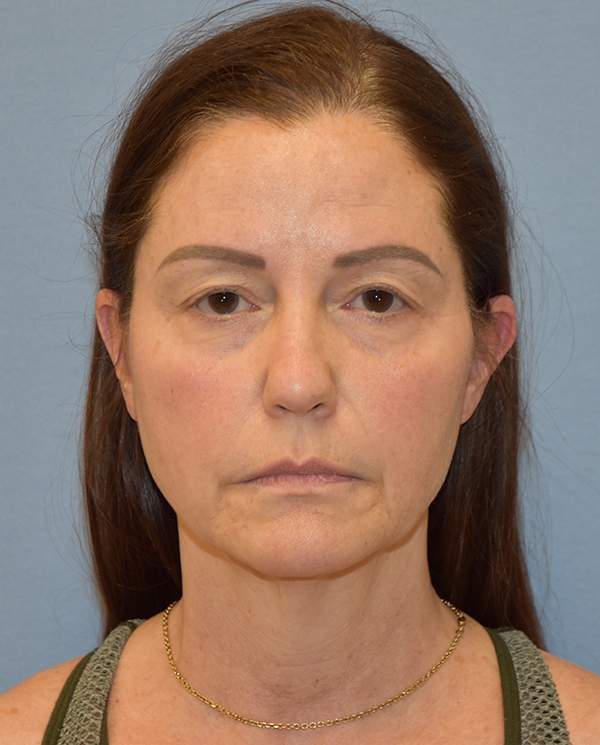 Facelift